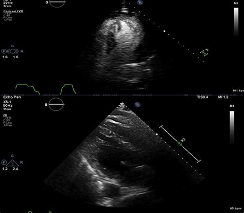 lvef transthoracic echo